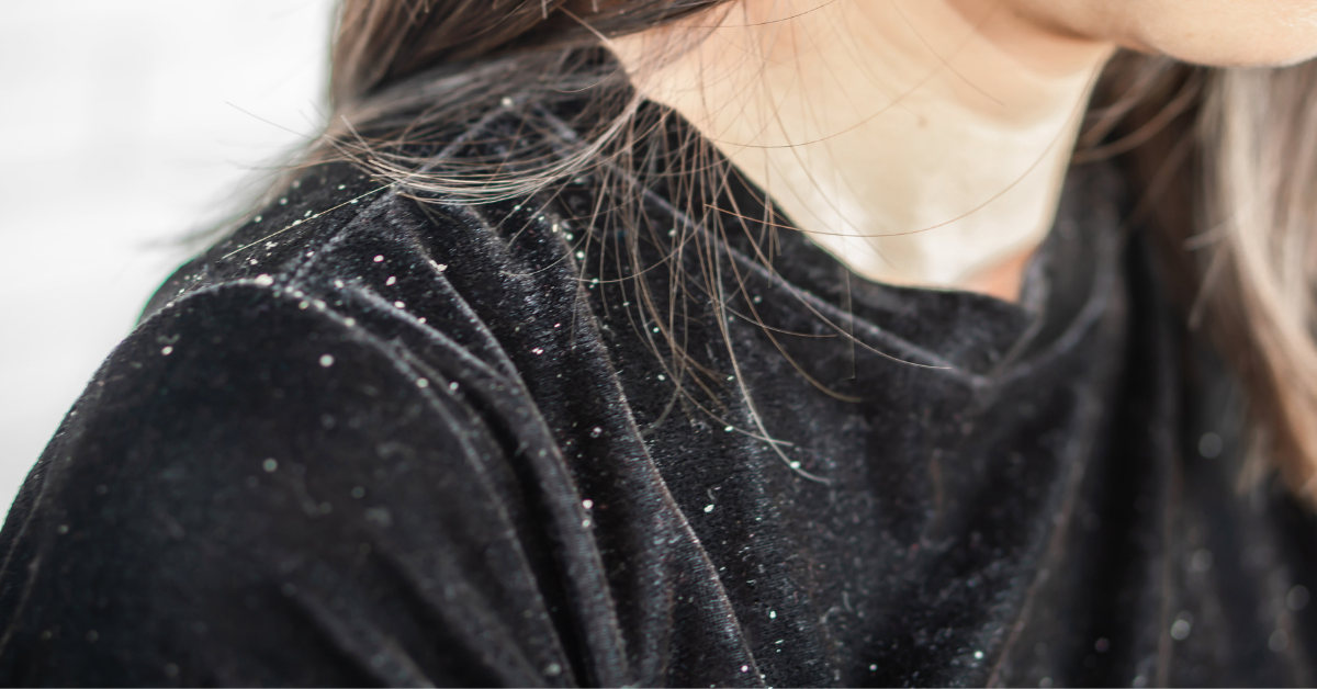 Kas mul on kuiv peanahk või kõõm?