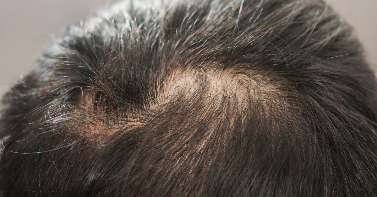 Kuidas peatada juuste väljalangemine